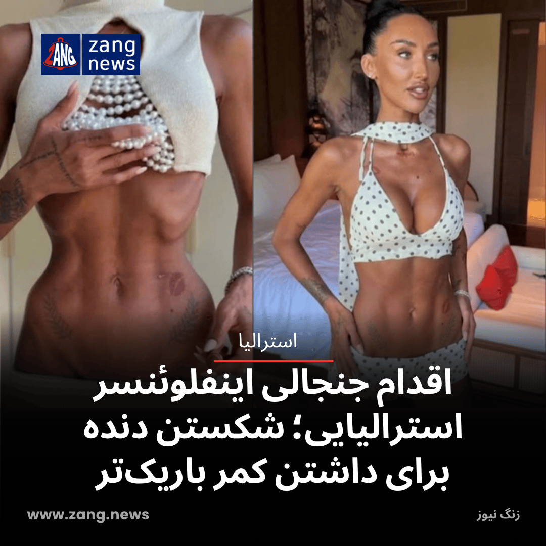 اقدام جنجالی اینفلوئنسر استرالیایی؛ شکستن دنده برای داشتن کمر باریک‌تر
