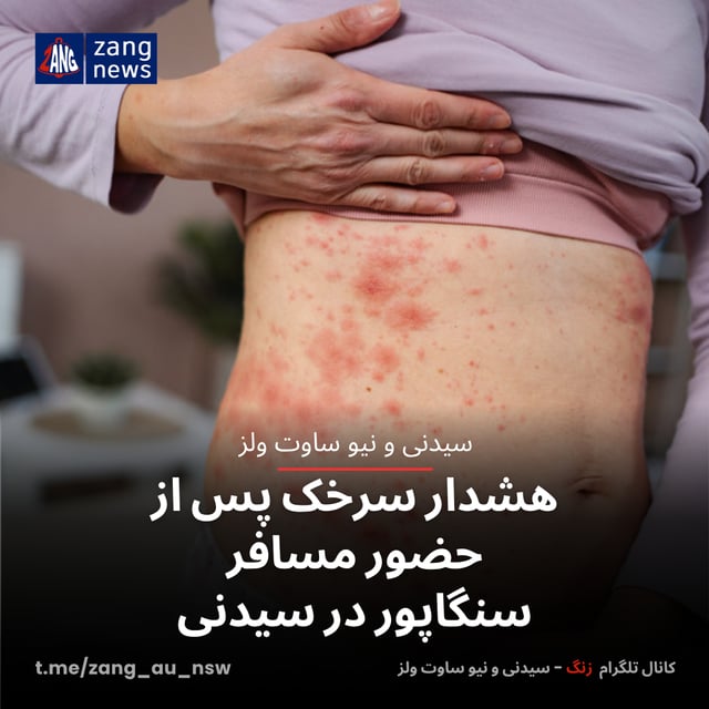 هشدار سرخک پس از حضور مسافر سنگاپور در سیدنی