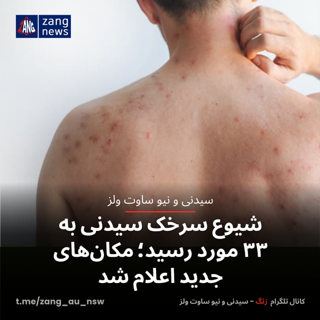 شیوع سرخک سیدنی به ۳۳ مورد رسید؛ مکان‌های جدید اعلام شد