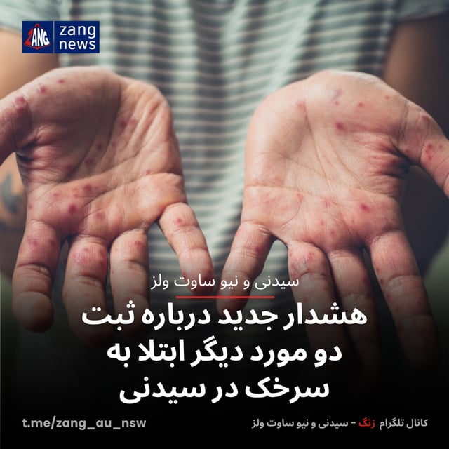 هشدار جدید درباره ثبت دو مورد دیگر ابتلا به سرخک در سیدنی